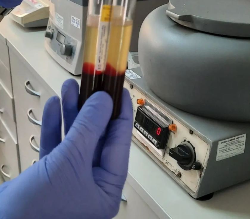 PRP (plasma rico en plaquetas.